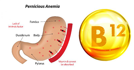 کم‌خونی پرنیشیوز, کم خونی فقر ویتامین ب 12