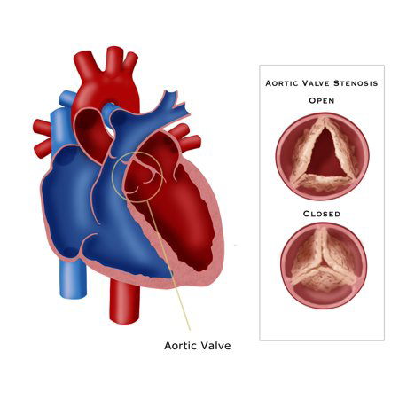 عمل دریچه آئورت قلب, درمان تنگی دریچه آئورت