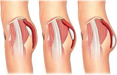 همه چیز درباره پروتز باسن, پروتز باسن