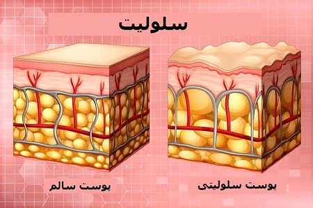 کرم ضد سلولیت, درمان سلولیت پا, ورزش برای رفع سلولیت