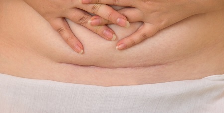 فتق جای عمل سزارین, علل بروز فتق بعد از سزارین, فتق بعد از سزارین
