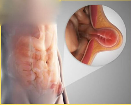 درمان فتق بعد از سزارین, عوامل خطر فتق سزارین, علایم فتق بعد از سزارین