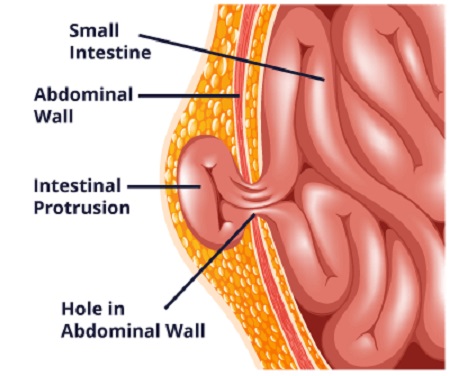 فتق جای عمل سزارین, علل بروز فتق بعد از سزارین, فتق بعد از سزارین