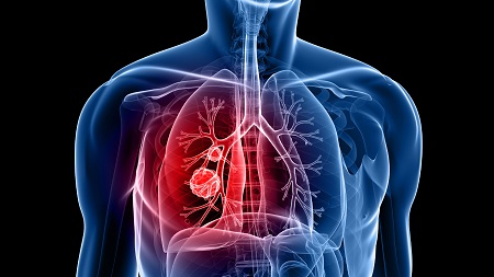 ورزش برای درمان اختلال مزمن تنفسی, درمان بیماری های COPD با ورزش, تمرینات ورزشی بیماری مزمن تنفسی