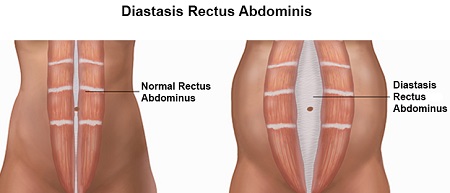 عضله عرضی شکمی, جدایش عضلات شکمی, عوارض بارداری