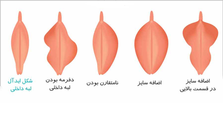 انواع واژن زنان, شکل انواع واژن