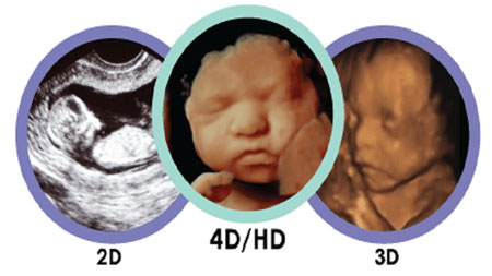 سونوگرافی چهار بعدی, سونوگرافی چهار بعدی چیست, سونوگرافی چهار بعدی جنین