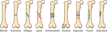 خطر افتادن در دوران بارداری, دلایل شکستگی استخوان در بارداری, انواع شکستگی ها در دوران بارداری
