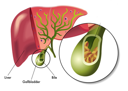 کیسه صفرا و بیماریهای آن ،بیماری صفراوی