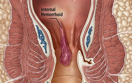 علل بواسیر خارجی, عکس بواسیر خارجی, بواسیر خارجی گوشتی