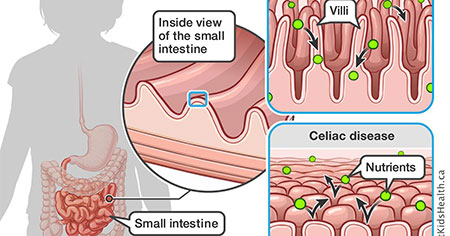 سلیاک چه نوع بیماری است ,بیماری سلیاک چیست و درمان