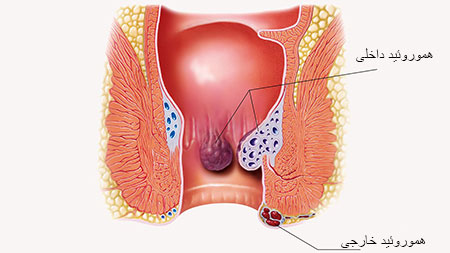 علائم بواسیر داخلی چیست,علائم بواسیر داخلی