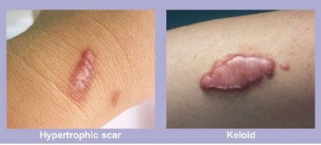 اسکار هیپرتروفیک, اسکار هیپرتروفیک چیست, درمان اسکار هیپرتروفیک تزریق بلومایسین