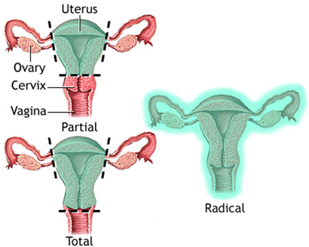علایم هیسترکتومی, هیسترکتومی واژینال