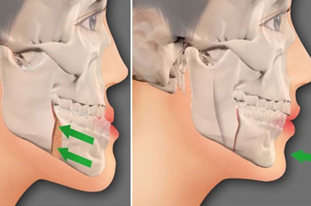 جراحی فک,نتیجه جراحی فک,فک جلو زده