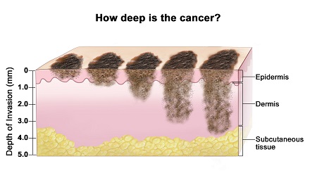 عکس از بیماری ملانوما, ملانوما چیست, سرطان پوست
