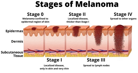 علایم ملانوما, راههای درمان ملانوما, ملانوما