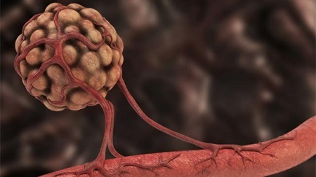 عوامل شکل گیری متاستاز علائم متاستاز سرطان, مکانیسم متاستاز, متاستاز چیست