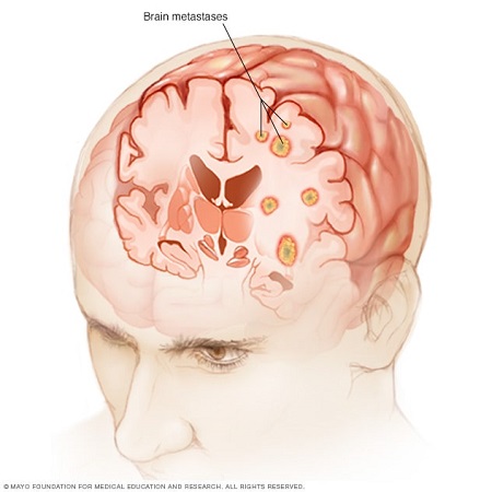 شیوه درمان متاستاز تشخیص متاستاز, علائم متاستاز سرطان, مکانیسم متاستاز