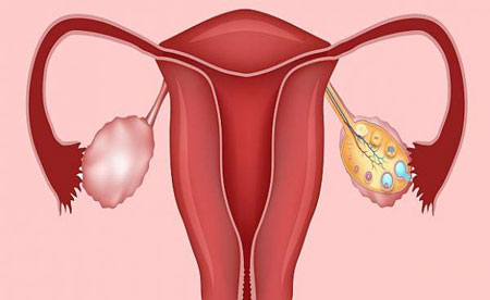 تنبلی تخمدان, درمان تنبلی تخمدان, تنبلی تخمدان و بارداری