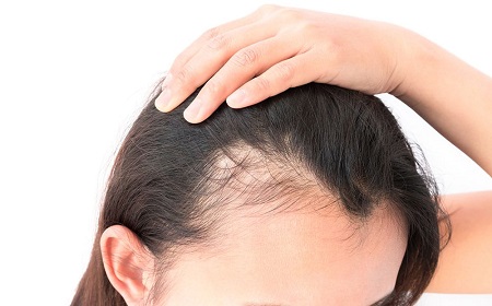 عوامل موثر در بیماری آب مروارید, ریزش مو, بیماریهای مو