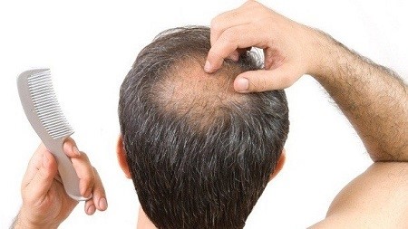 راههای درمان بیماری مروارید مو, علت اصلی ریزش مو, بیماری مروارید مو