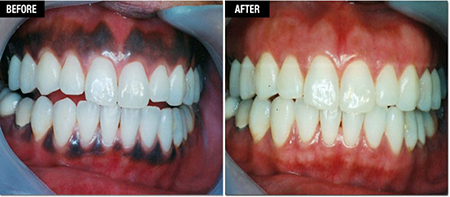 علت سیاه شدن لثه, راه‌های درمان لثه‌های سیاه