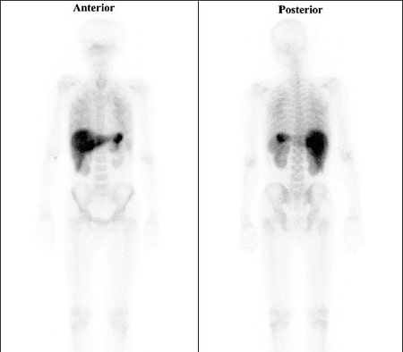 اسکن استخوان, اسکن رادیوایزوتوپ, اسکن رادیوایزوتوپ چیست