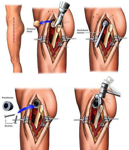 آرتروپلاستی مفصل هیپ , عوارض تعویض مفصل ران