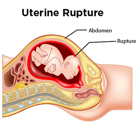 پارگی رحم در اثر ضربه, علایم پارگی رحم در زایمان طبیعی, عوارض پارگی رحم در زایمان طبیعی