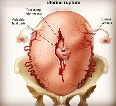 علت پارگی رحم, پارگی رحم, علائم پارگی رحم