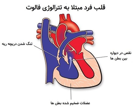تترالوژی فالوت, تترالوژی فالوت چیست, علت بیماری تترالوژی فالوت