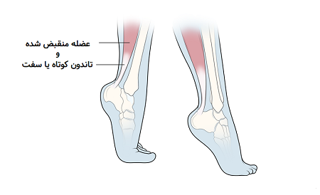 راه رفتن روی نوک پنجه پا در کودکان, روی پنجه راه رفتن کودکان, راه رفتن کودک روی انگشتان پا