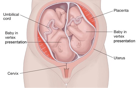 نحوه قرارگیری جنین های دوقلو در رحم, قرارگیری جنین های دوقلو در رحم, وضعیت قرارگیری جنین در رحم