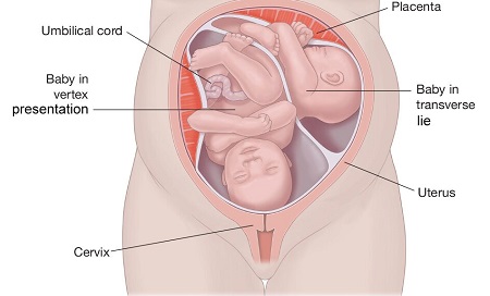 نحوه قرارگیری جنین های دوقلو در رحم, قرارگیری جنین های دوقلو در رحم, وضعیت قرارگیری جنین در رحم