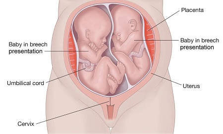 وضعیت قرارگیری جنین های دوقلو, جنین دوقلو, عکس جنین دوقلو در رحم