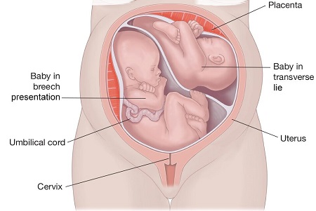 نحوه قرارگیری جنین های دوقلو در رحم, قرارگیری جنین های دوقلو در رحم, وضعیت قرارگیری جنین در رحم