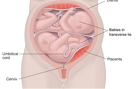 وضعیت قرارگیری جنین در رحم, بارداری دوقلو, وضعیت سرپایین دوقلوها