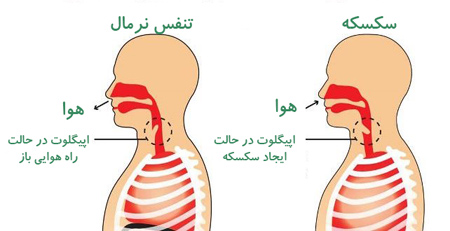 آشنایی با سکسکه,درباره سکسکه