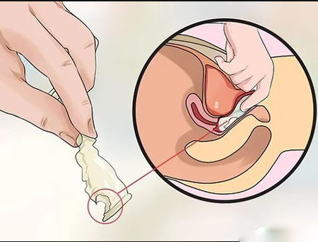 جا ماندن کاندوم در رحم, علت جا ماندن کاندوم در واژن, عوارض جا ماندن کاندوم در واژن