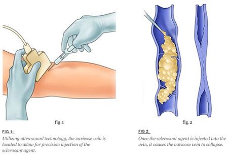 درد اسکلروتراپی, اسکلروتراپی واریس, اسکلروتراپی