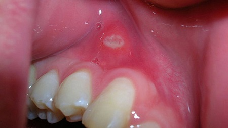 پیشگیری از ایجاد آفت دهان , تفاوت های آفت دهان در کودکان با تبخال , نشانه آفت دهان در کودکان