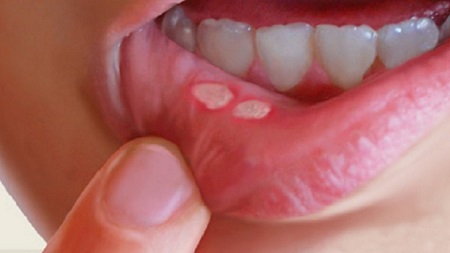 درد آفت دهان در کودکان, آفت دهان در کودک 2 ساله , نشانه های آفت دهان در کودکان