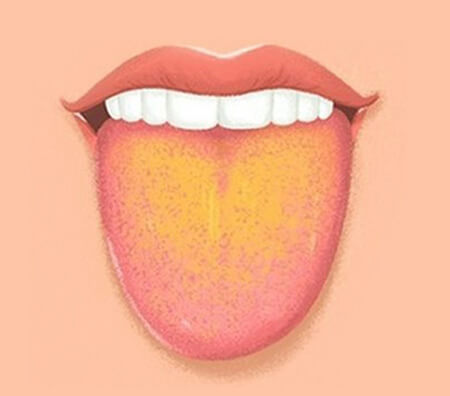 زبان زرد نشانه چیست, علت زردی روی زبان