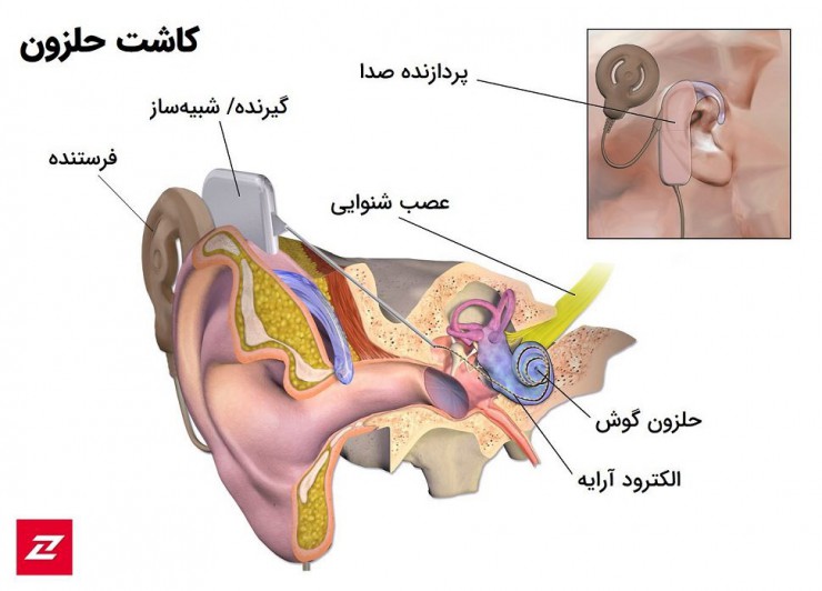 Cochlear implant / کاشت حلزون