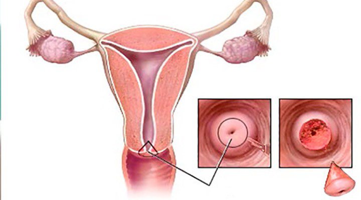 بیوپسی مخروطی برای تشخیص سرطان دهانه رحم