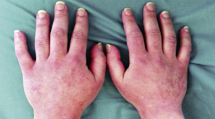 آلرژی به لاتکس یکی از مشکلات شایع پوستی است