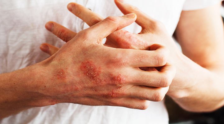 اگزما یکی از شایع ترین مشکلات پوستی است
