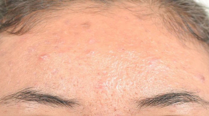 درماتیت سبوریکا یکی از شایع ترین مشکلات پوستی است