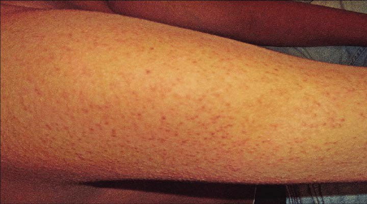 کراتوز پیلاریس یکی از شایع ترین مشکلات پوستی است